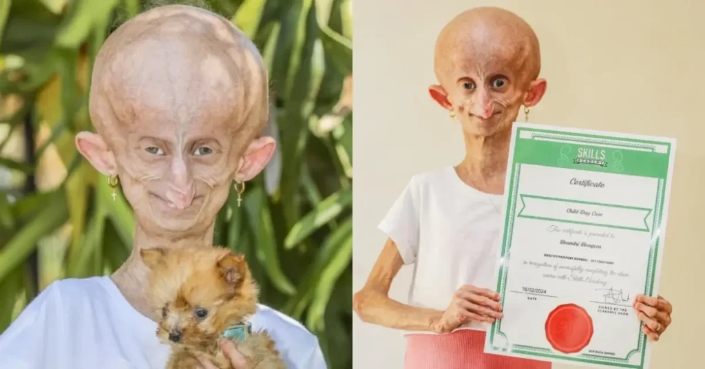 Beandri Booysen Age, Height, and Weight: Living with Progeria